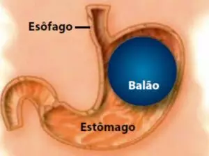 Balão Intragástrico